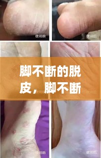 腳不斷的脫皮，腳不斷脫皮還癢 