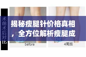 揭秘瘦腿針價(jià)格真相，全方位解析瘦腿成本！