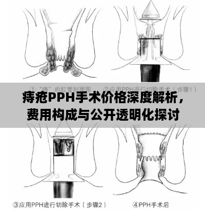 痔瘡PPH手術(shù)價格深度解析，費用構(gòu)成與公開透明化探討