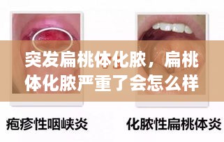 突發(fā)扁桃體化膿，扁桃體化膿嚴重了會怎么樣了 