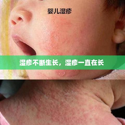 濕疹不斷生長(zhǎng)，濕疹一直在長(zhǎng) 
